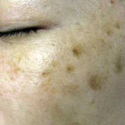 POST-ACNE PIGMENTATION