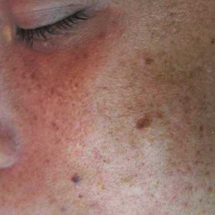 POST-INFLAMMATORY HYPERPIGMENTATION (PIH)