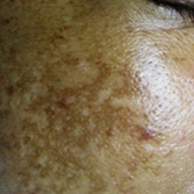 Causes of Dark Spots (Part 2)