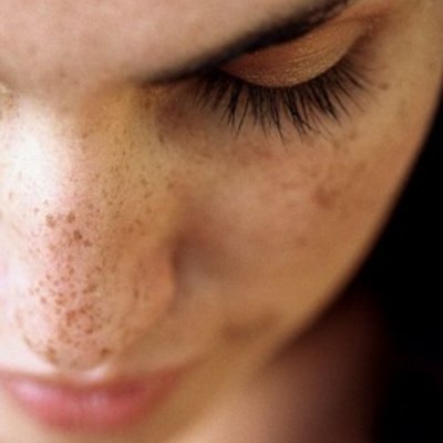 没想到长黑斑居然是因为这样。。。